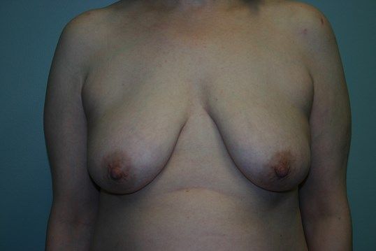 Breast Lift Before & After