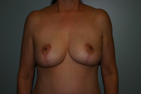 Breast Lift Before & After