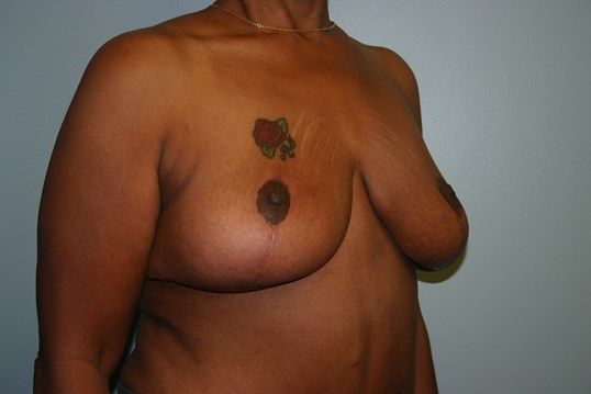 Breast Lift Before & After