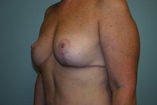 Breast Lift Before & After