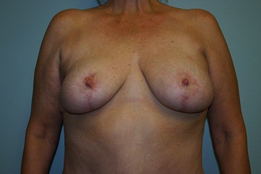 Breast Lift Before & After