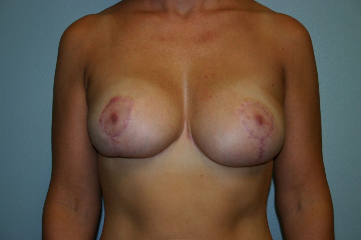 Breast Lift Before & After