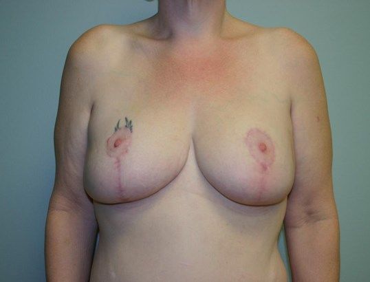 Breast Lift Before & After