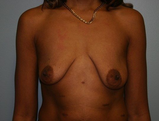 Breast Lift Before & After