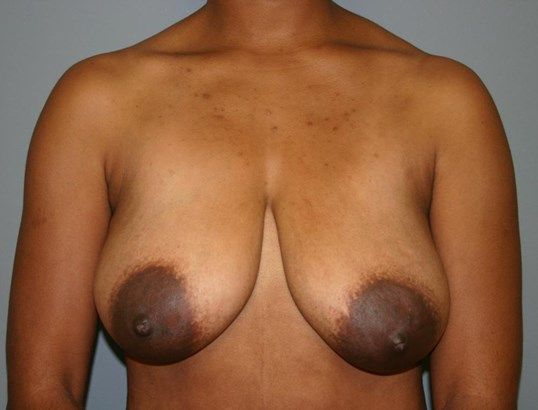 Breast Lift Before & After