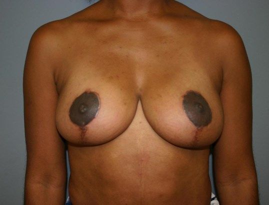 Breast Lift Before & After