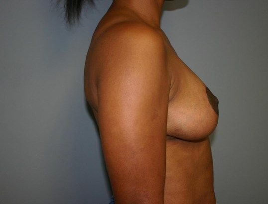 Breast Lift Before & After