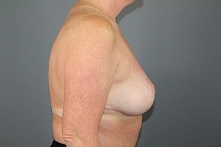 Breast Lift Before & After