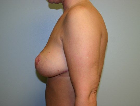 Breast Lift Before & After