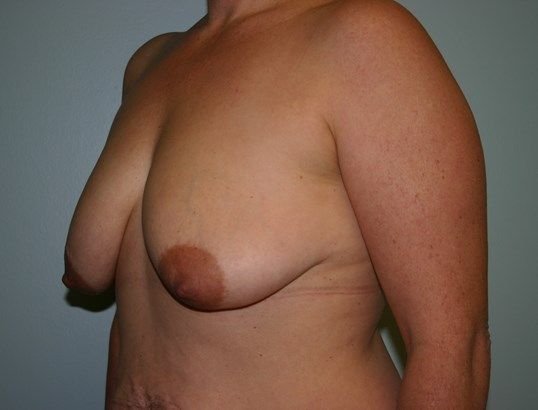 Breast Lift Before & After