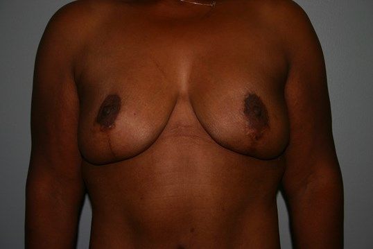Breast Lift Before & After