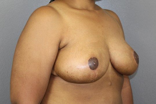 Breast Lift Before & After