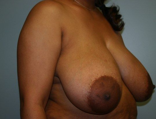 Breast Lift Before & After