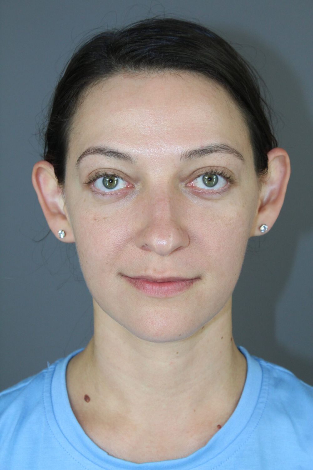 Rhinoplasty Before & After