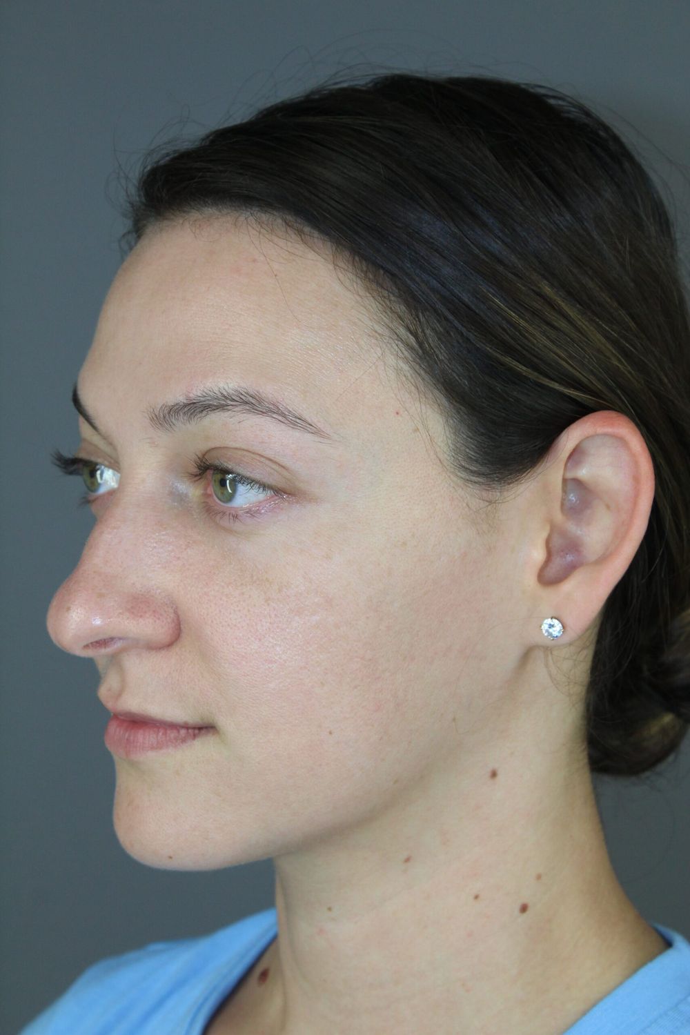 Rhinoplasty Before & After