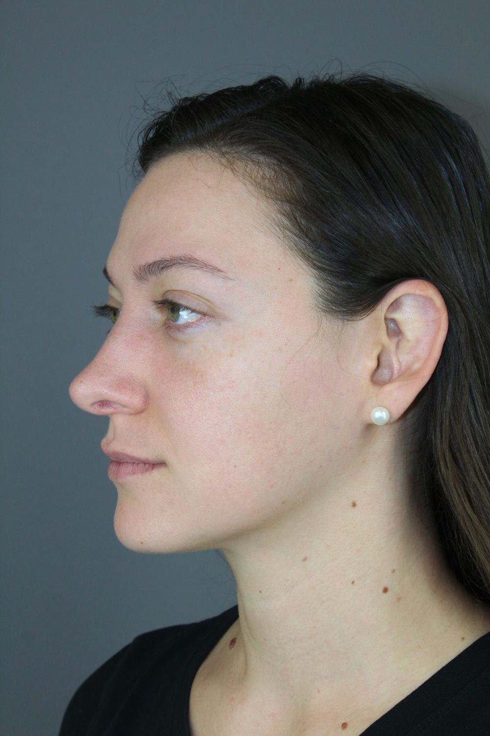 Rhinoplasty Before & After