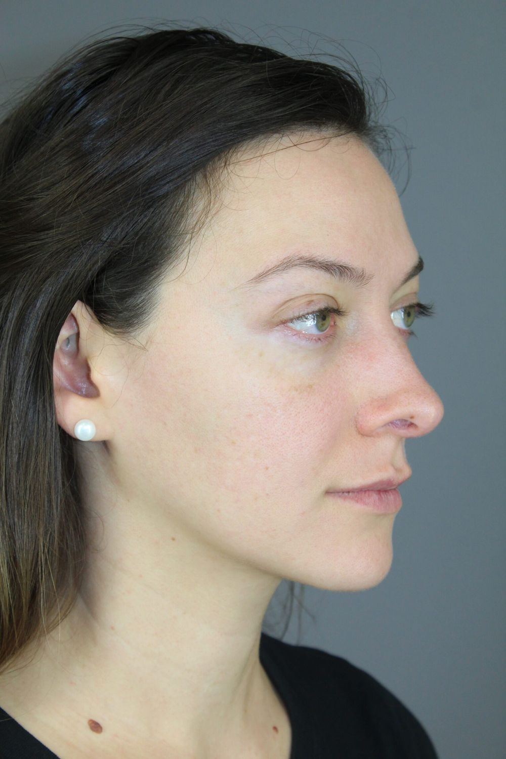 Rhinoplasty Before & After