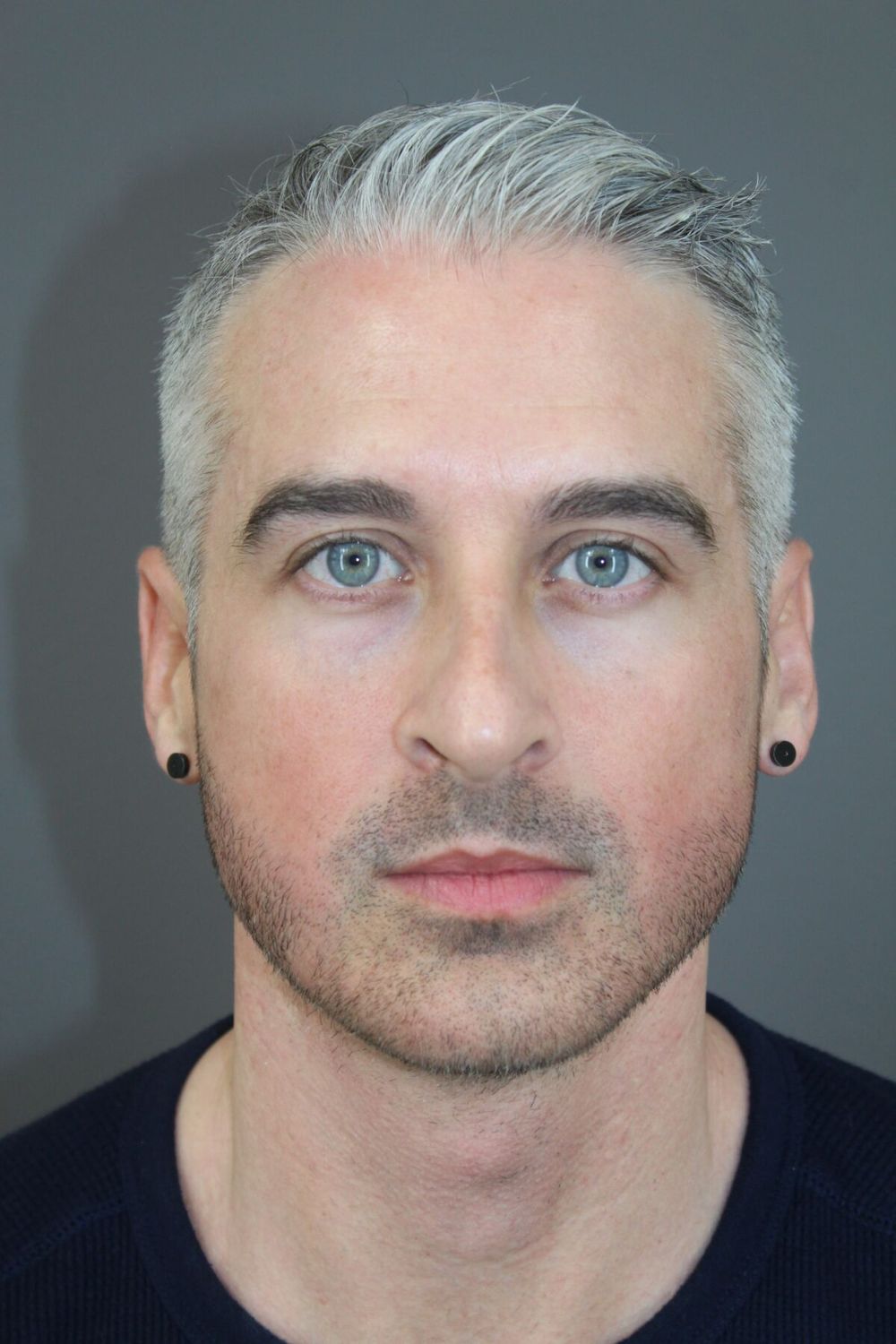 Rhinoplasty Before & After