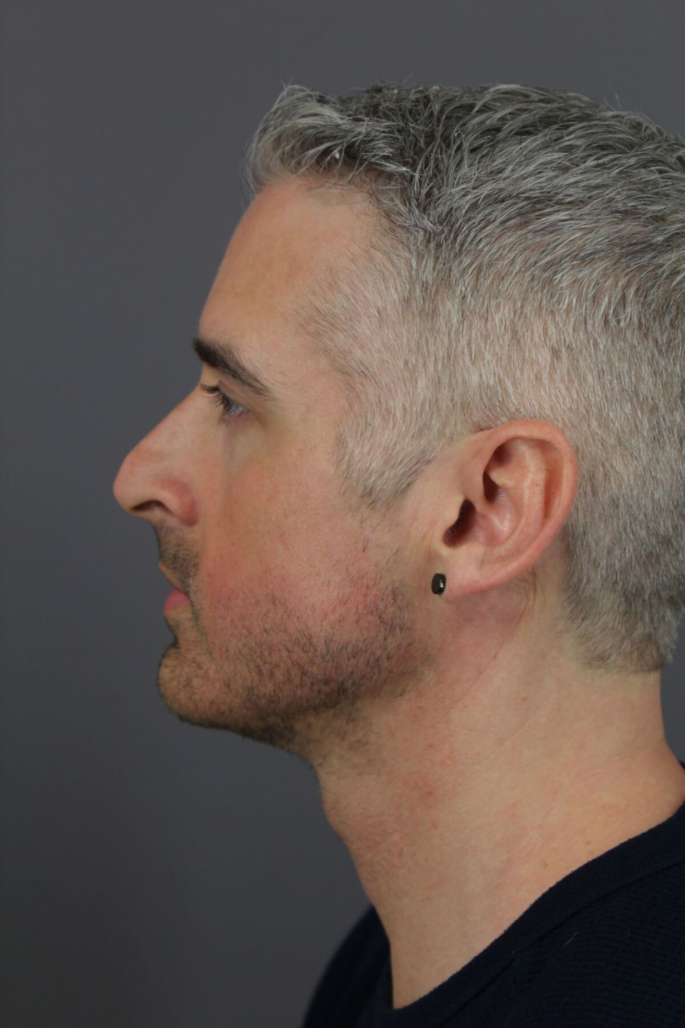 Rhinoplasty Before & After