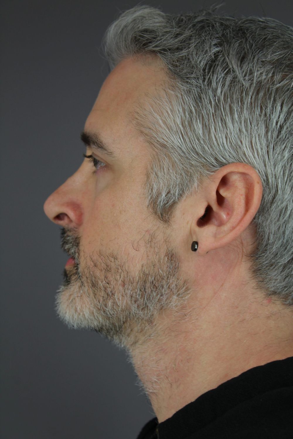 Rhinoplasty Before & After