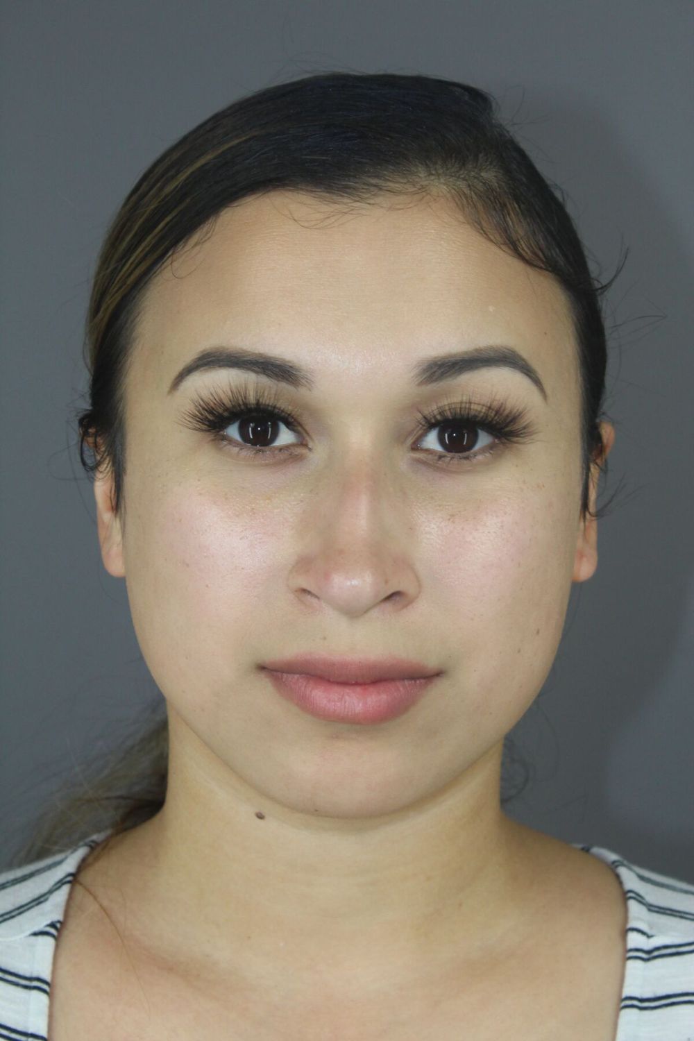 Rhinoplasty Before & After