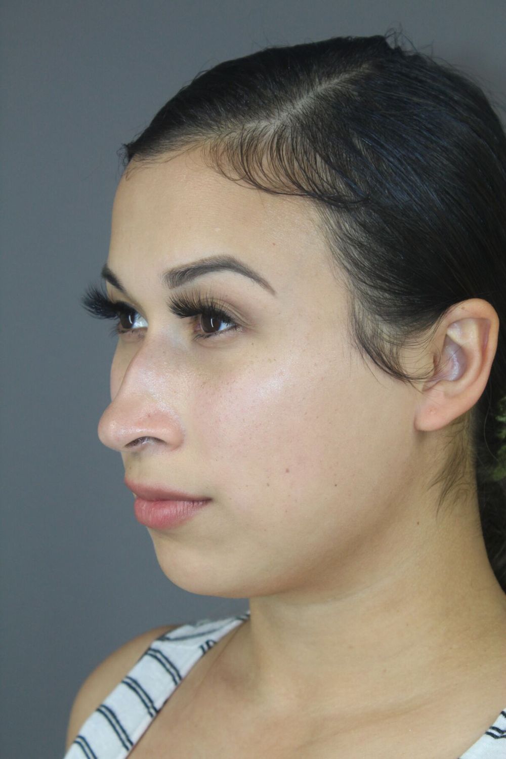 Rhinoplasty Before & After