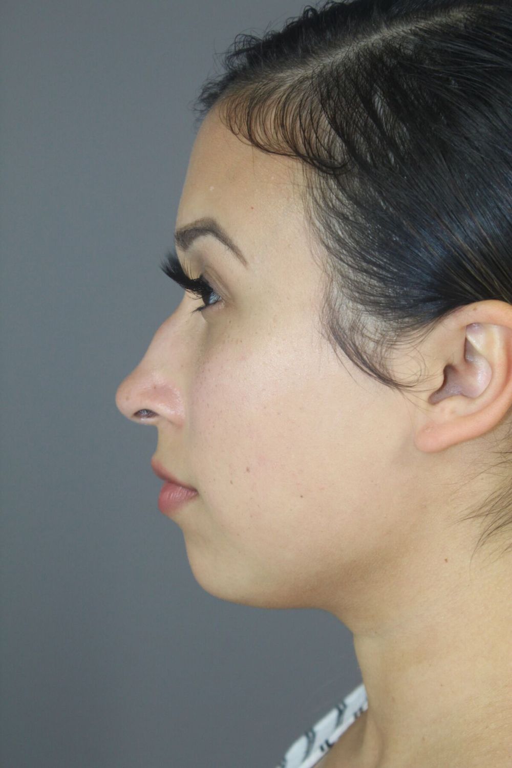 Rhinoplasty Before & After