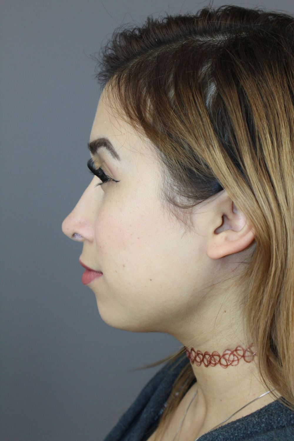 Rhinoplasty Before & After