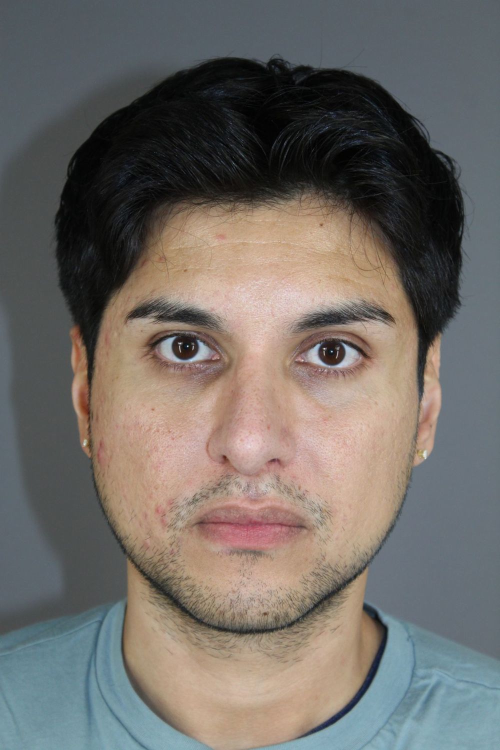 Rhinoplasty Before & After