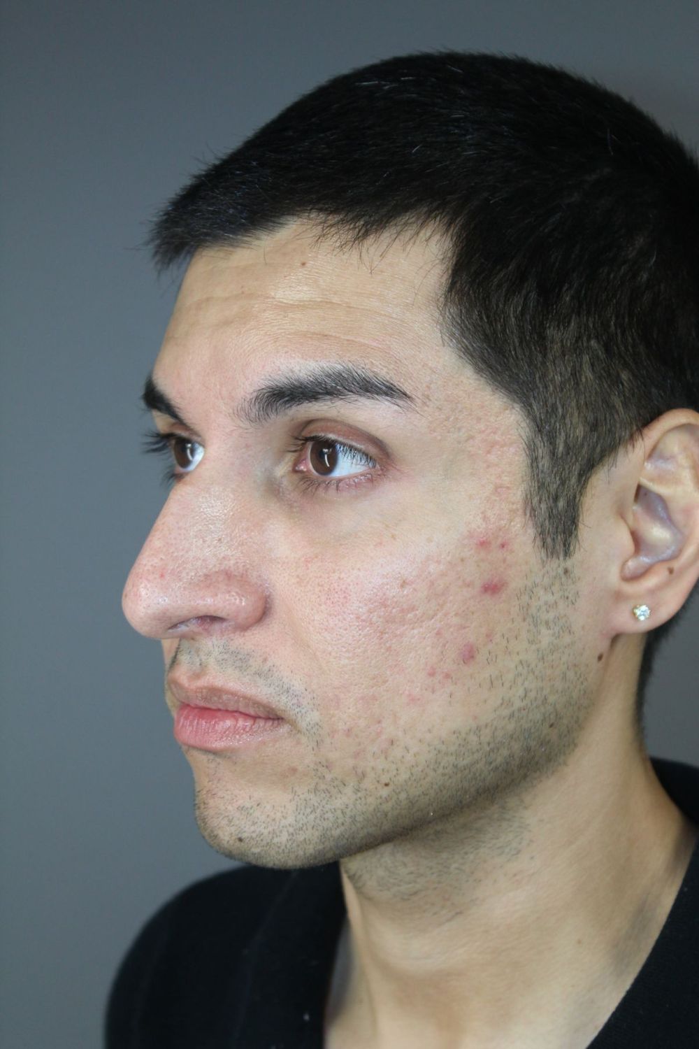 Rhinoplasty Before & After
