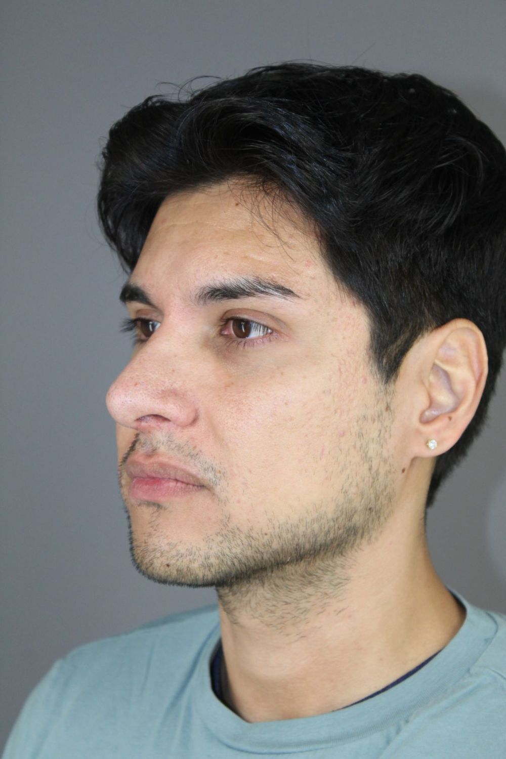 Rhinoplasty Before & After
