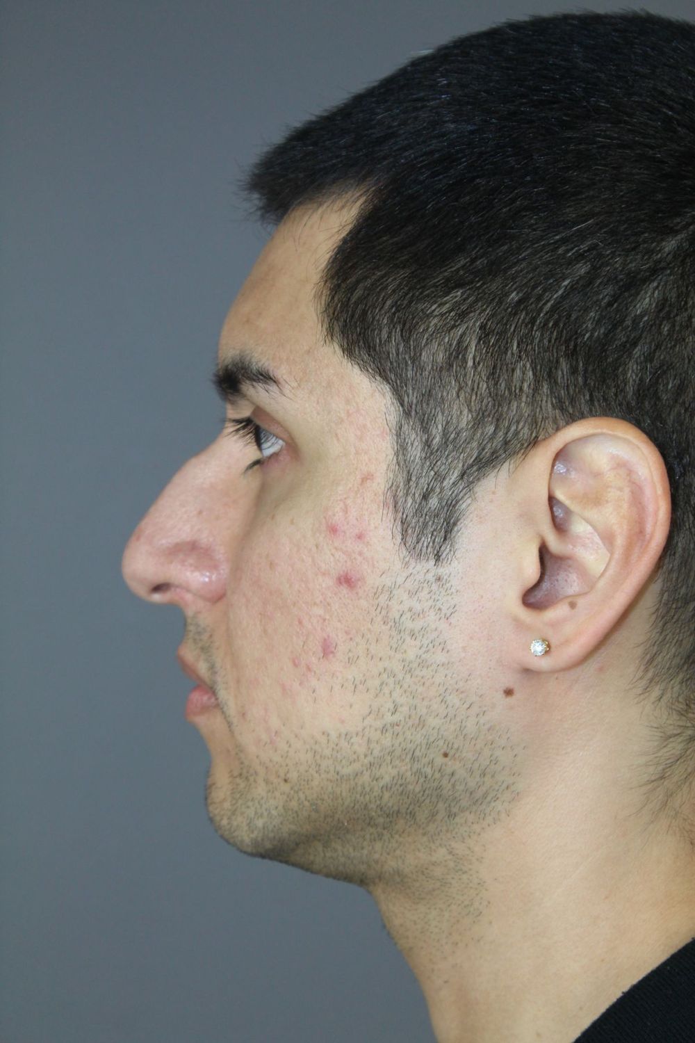 Rhinoplasty Before & After