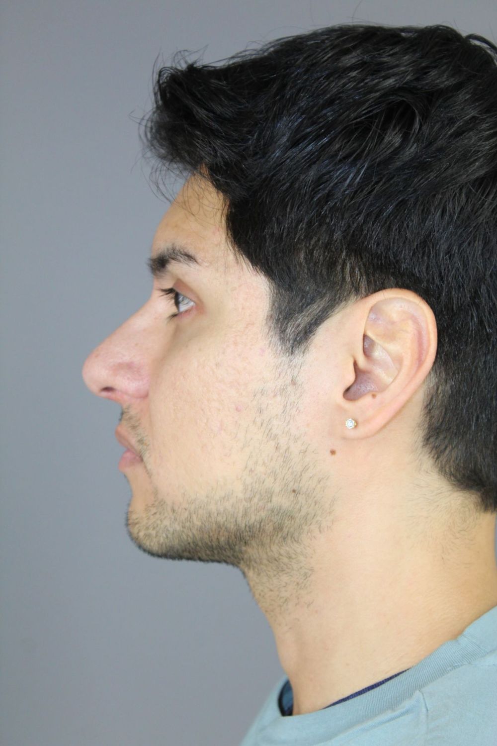 Rhinoplasty Before & After