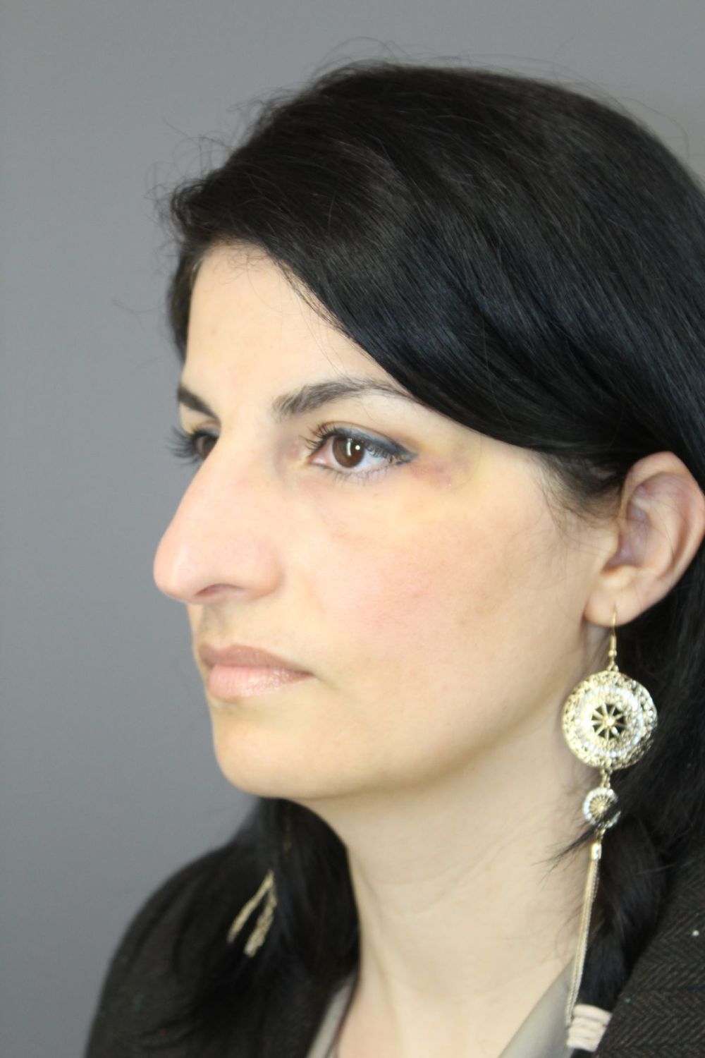 Rhinoplasty Before & After