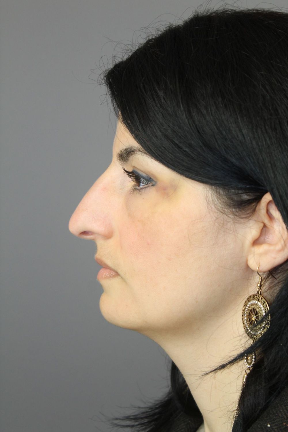 Rhinoplasty Before & After