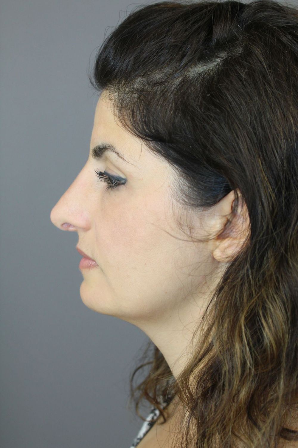 Rhinoplasty Before & After