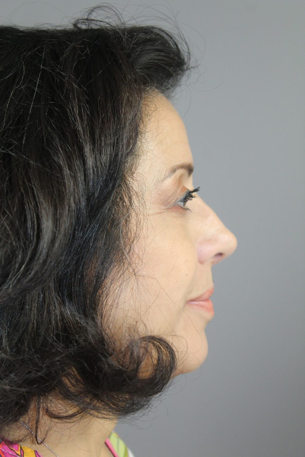 Rhinoplasty Before & After