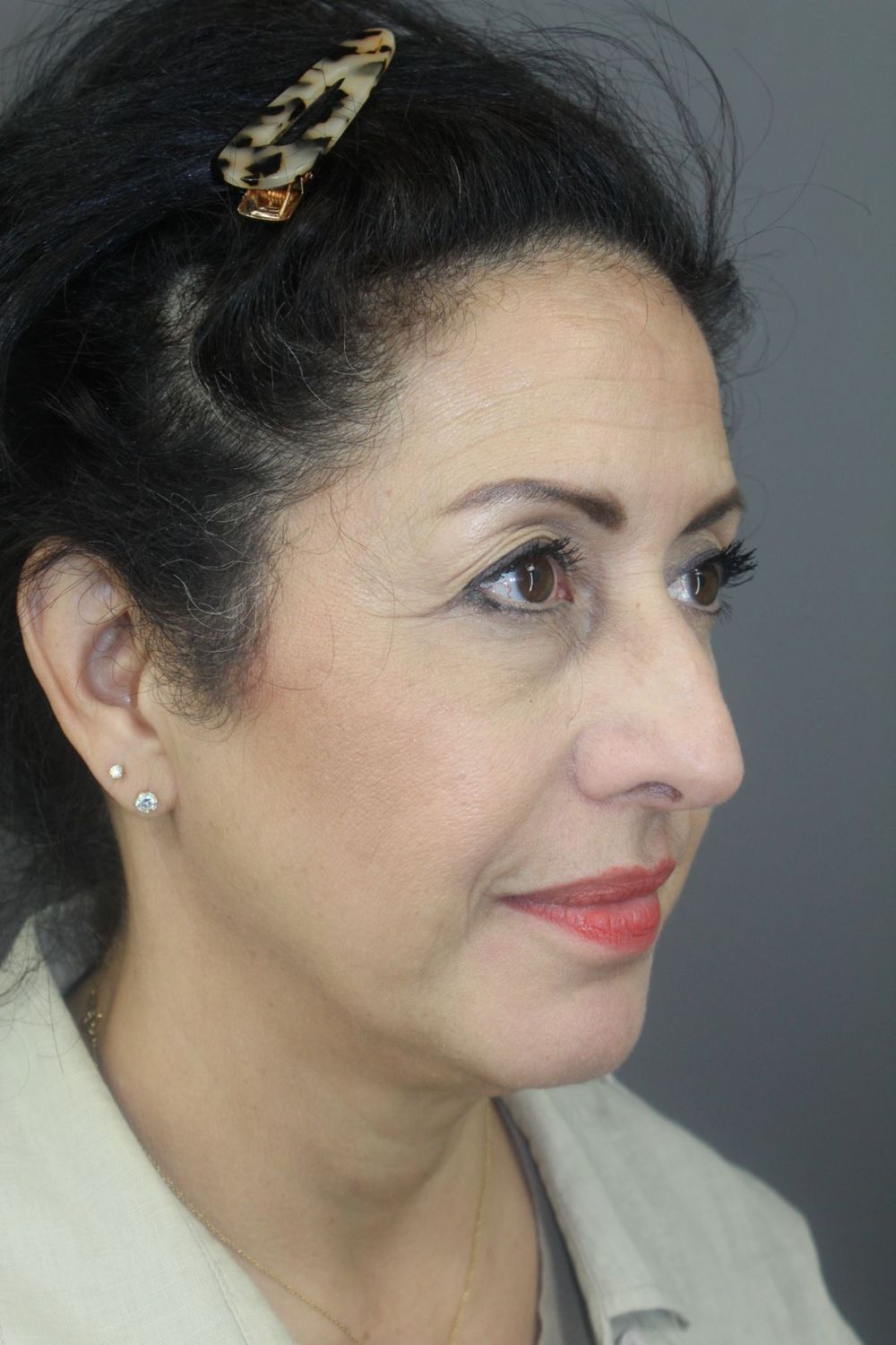 Rhinoplasty Before & After