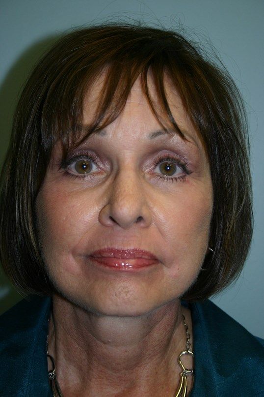 Rhinoplasty Before & After