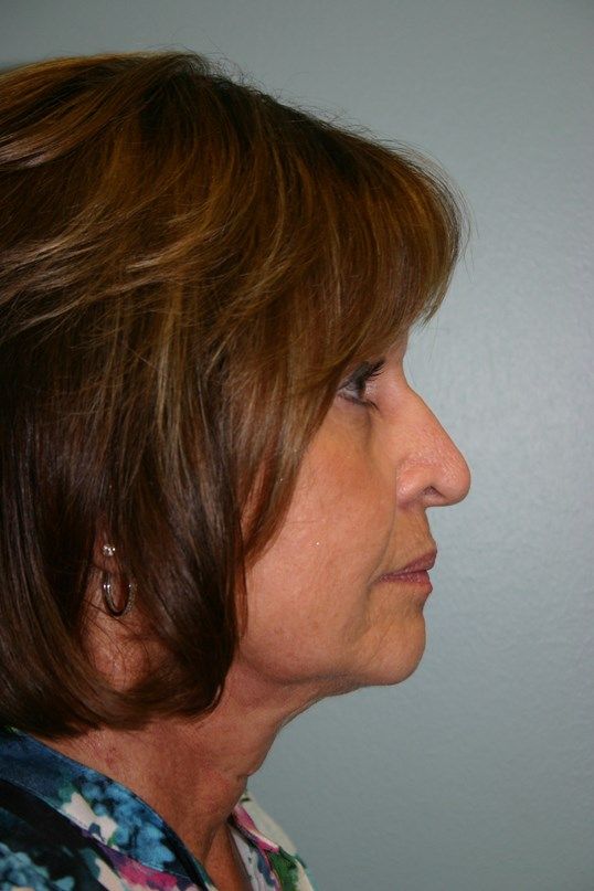 Rhinoplasty Before & After