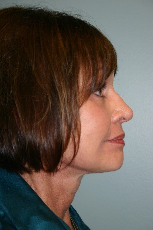 Rhinoplasty Before & After