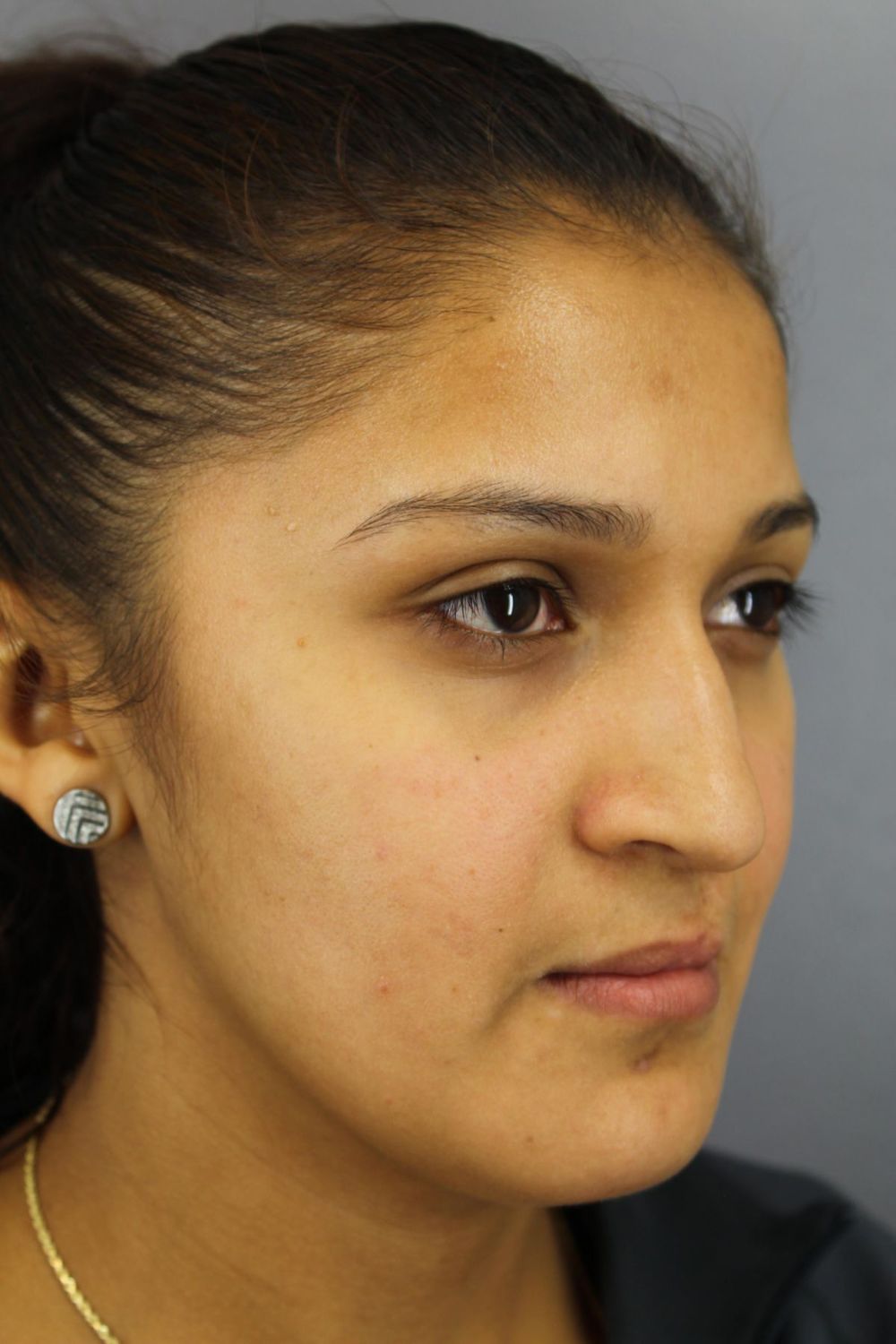 Rhinoplasty Before & After