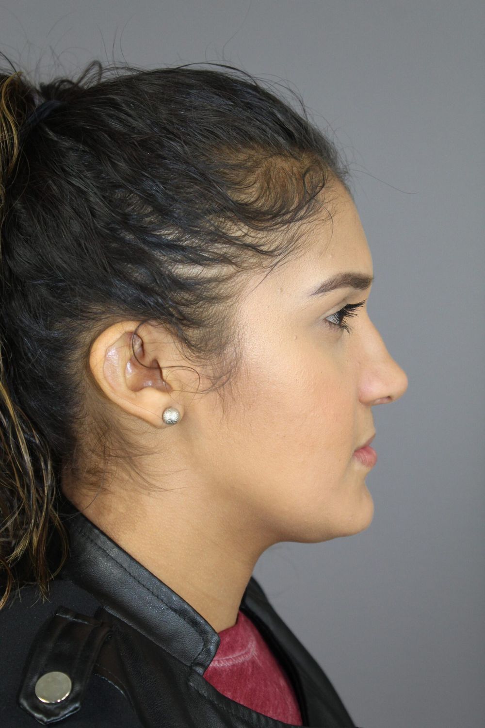 Rhinoplasty Before & After