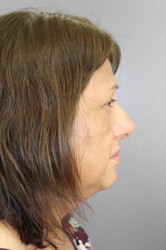 Rhinoplasty Before & After