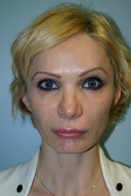 Rhinoplasty Before & After