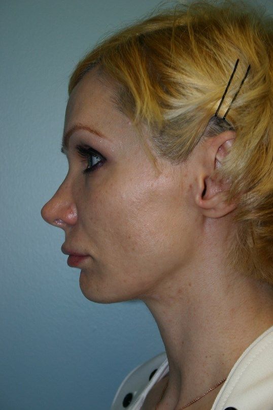 Rhinoplasty Before & After