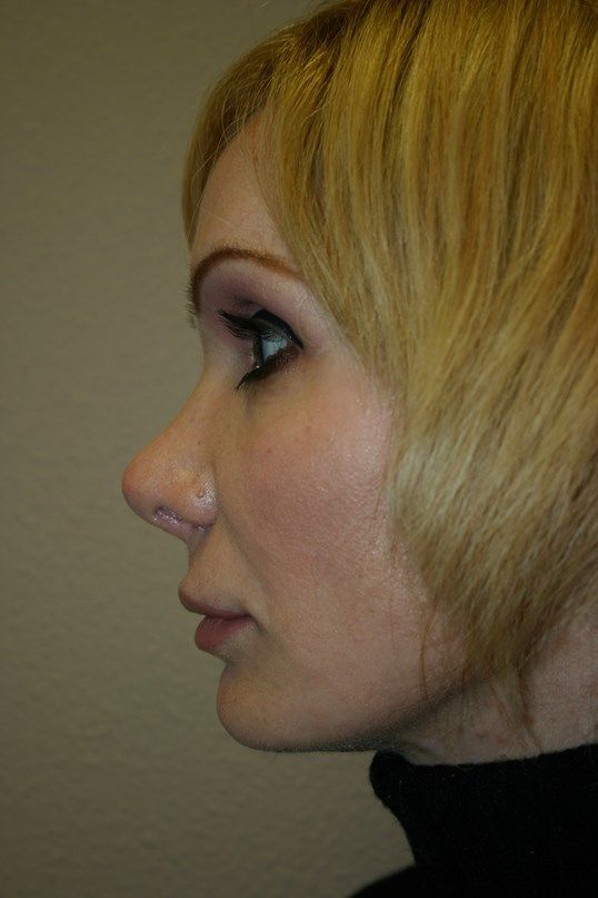 Rhinoplasty Before & After
