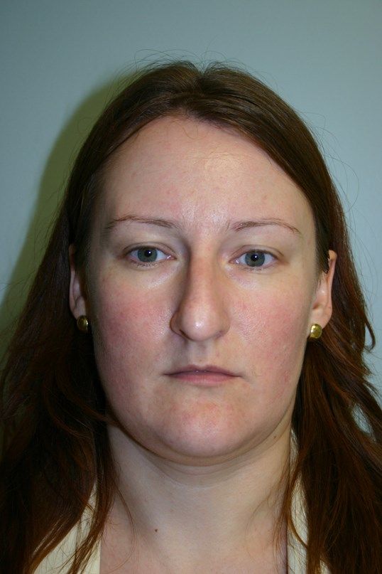 Rhinoplasty Before & After