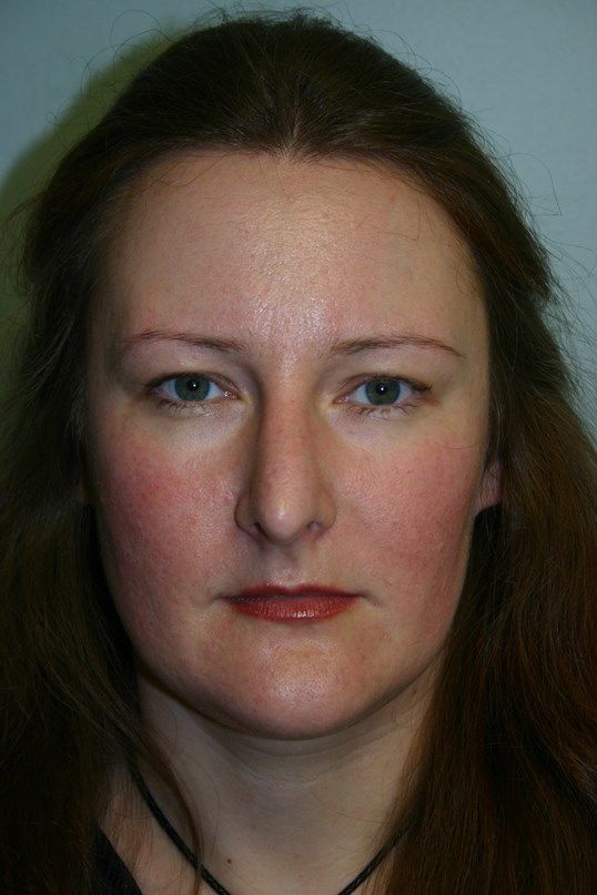 Rhinoplasty Before & After