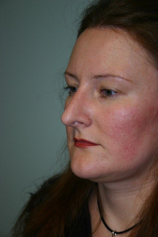 Rhinoplasty Before & After
